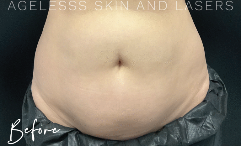 Before Image: CoolSculpting - front