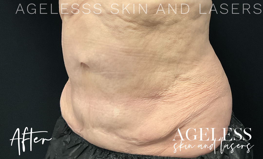 After Image: CoolSculpting - left-front-oblique