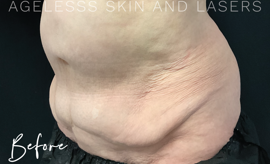 Before Image: CoolSculpting - left-front-oblique