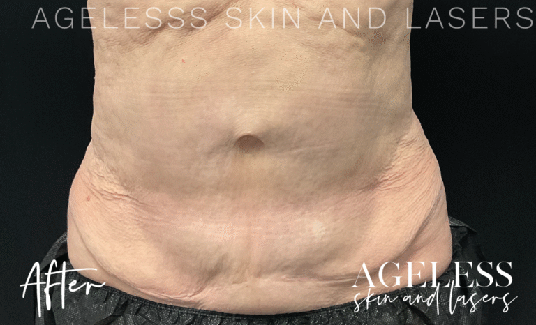 After Image: CoolSculpting - front