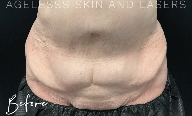 Before Image: CoolSculpting - front