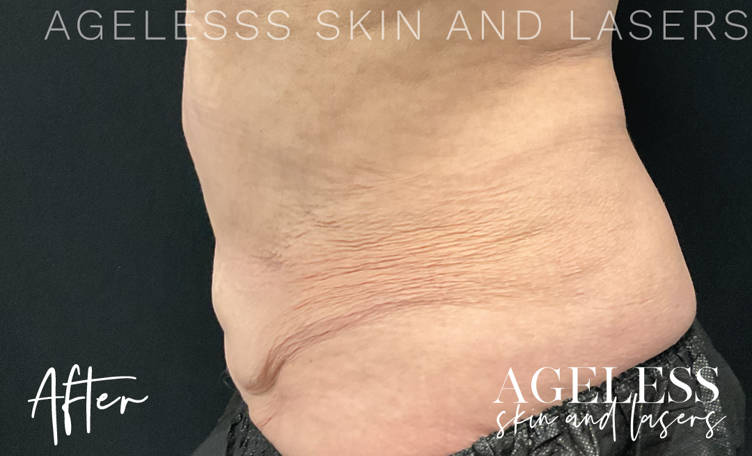 After Image: CoolSculpting - left-side