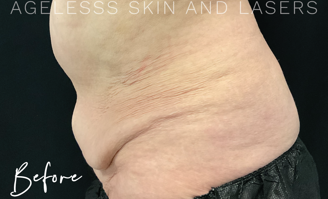 Before Image: CoolSculpting - left-side