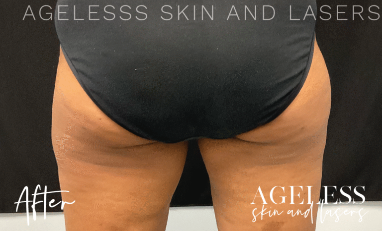 After Image: CoolSculpting - back