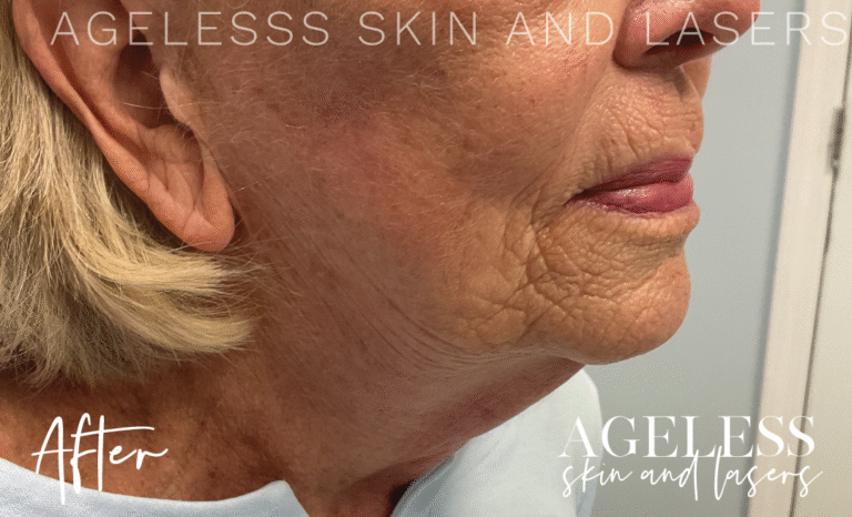 After Image: Radio Frequency Microneedling - right-front-oblique