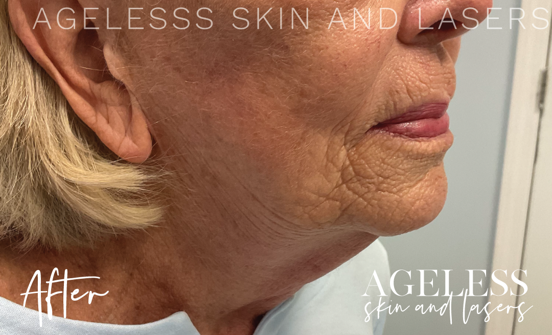 After Image: Radio Frequency Microneedling - right-front-oblique