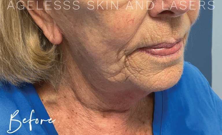 Before Image: Radio Frequency Microneedling - right-front-oblique