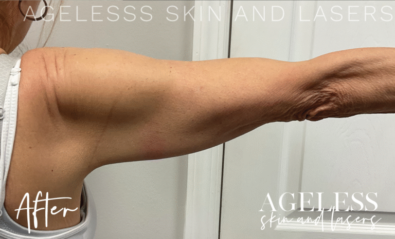 After Image: EMSculpt Neo - back