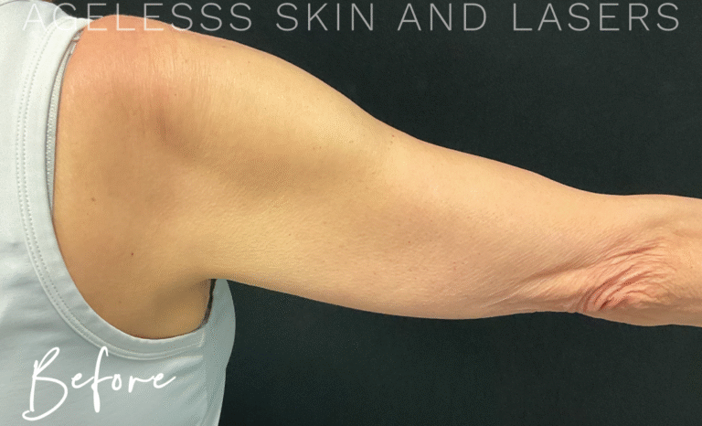 Before Image: EMSculpt Neo - back