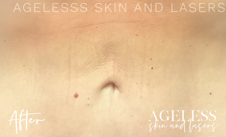 After Image: Skin Tightening and Radio Frequency Microneedling - front