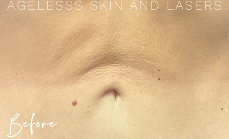 Before Image: Skin Tightening and Radio Frequency Microneedling - front