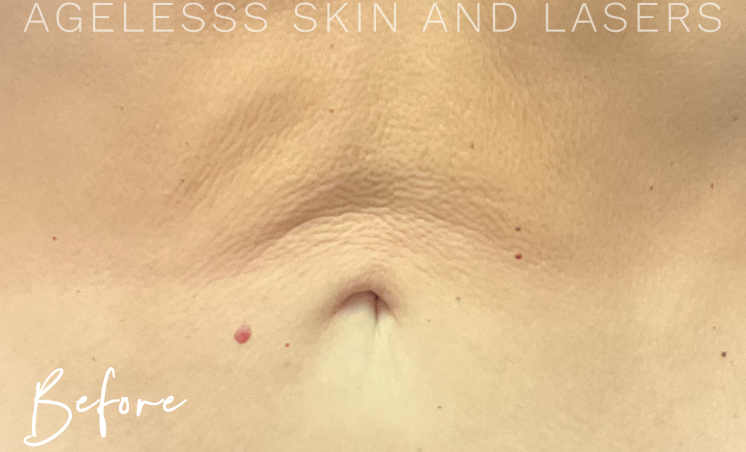 Before Image: Skin Tightening and Radio Frequency Microneedling - front