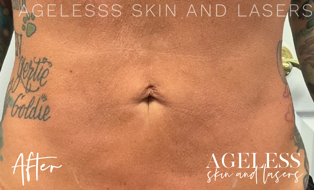 After Image: Skin Tightening and Radio Frequency Microneedling - front