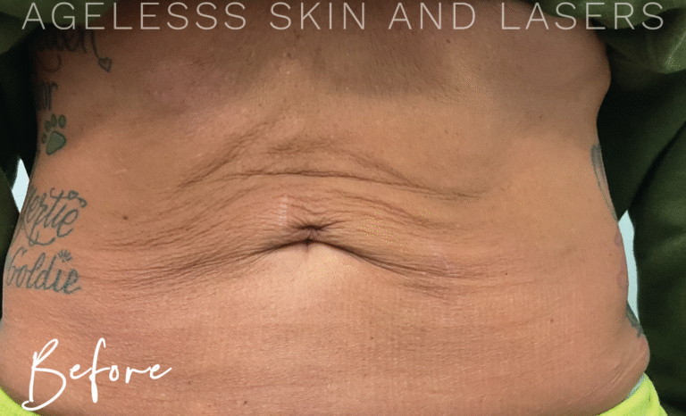 Before Image: Skin Tightening and Radio Frequency Microneedling - front