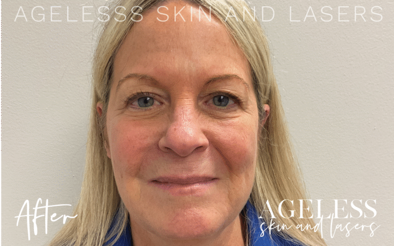 After Image: Microneedling - front