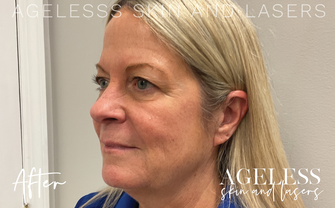 After Image: Microneedling - left-front-oblique