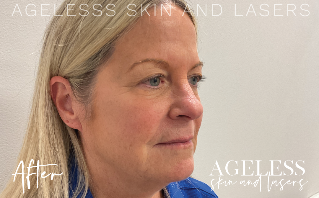 After Image: Microneedling - right-front-oblique