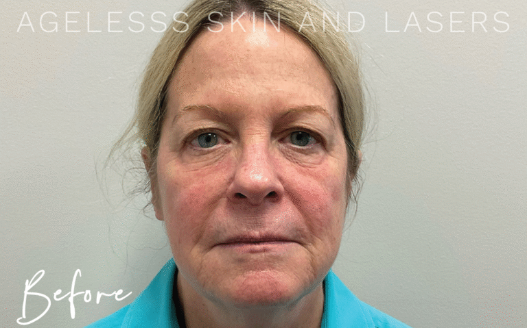 Before Image: Microneedling - front