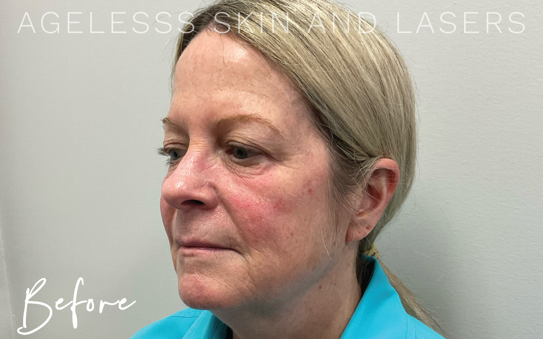 Before Image: Microneedling - left-front-oblique