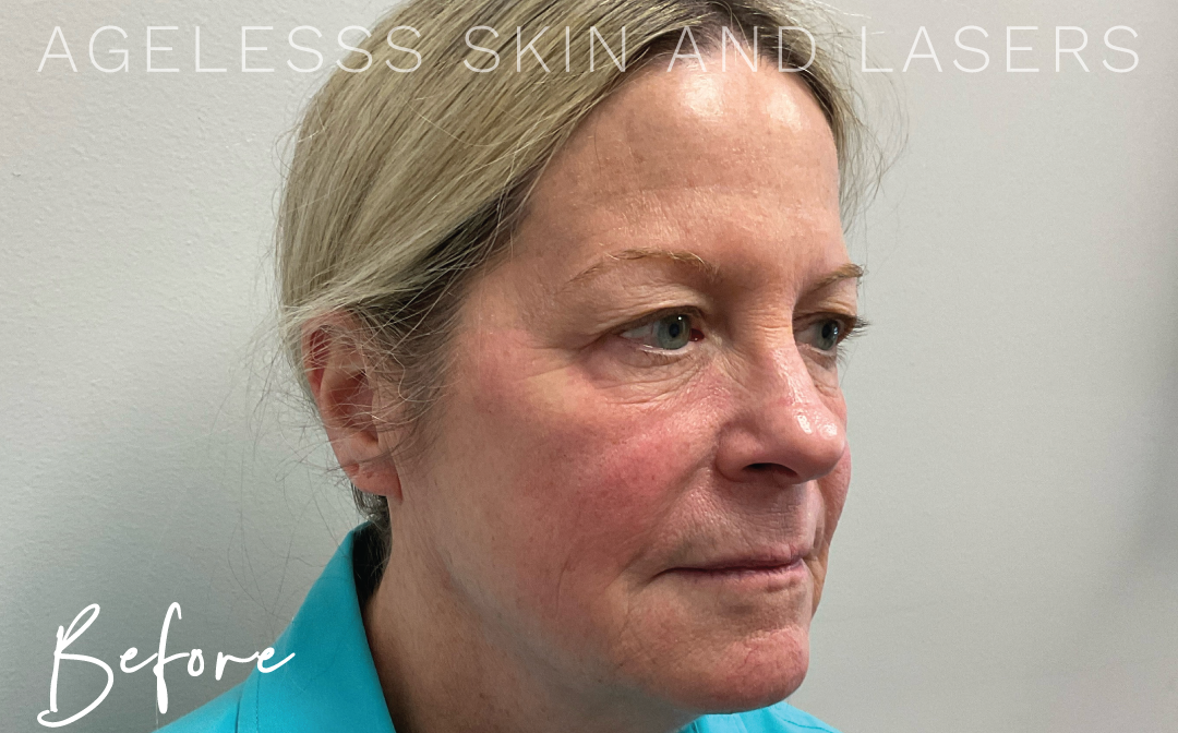 Before Image: Microneedling - right-front-oblique