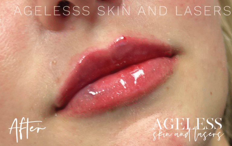 After Image: Lip Filler - right-front-oblique