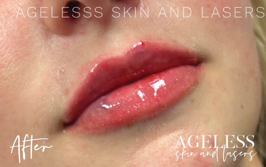 After Image: Lip Filler - right-front-oblique