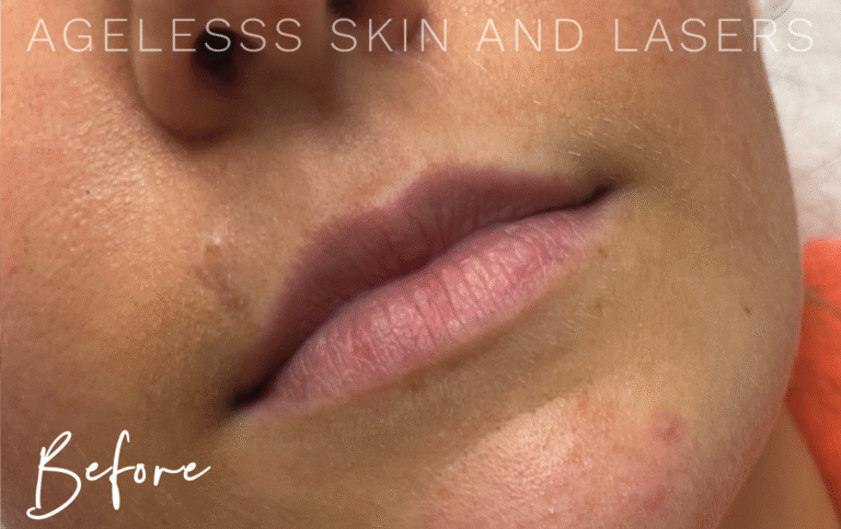 Before Image: Lip Filler - right-front-oblique