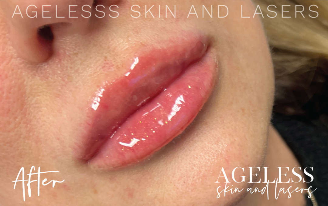 After Image: Lip Filler - right-front-oblique
