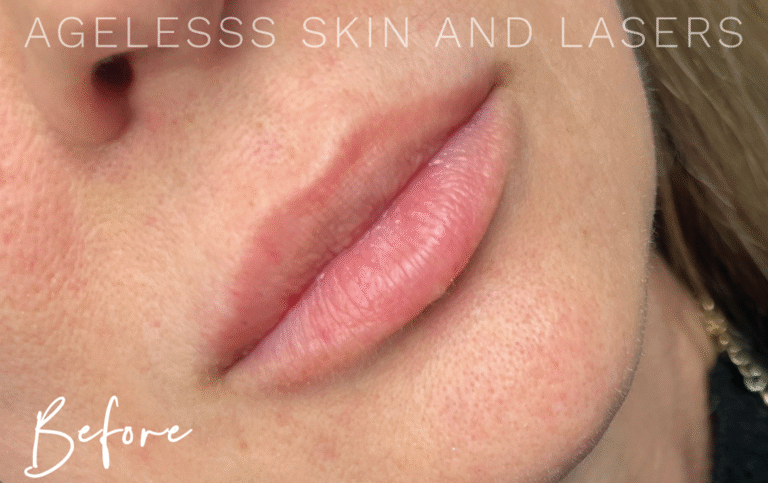 Before Image: Lip Filler - right-front-oblique