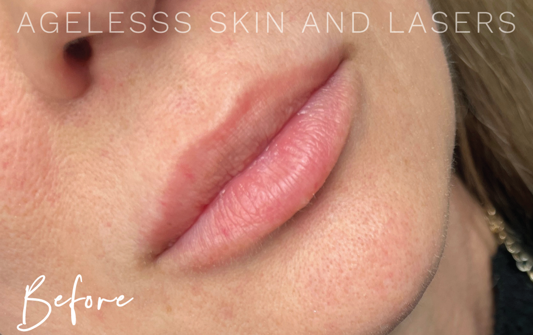 Before Image: Lip Filler - right-front-oblique