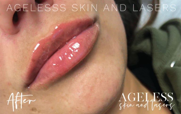 After Image: Lip Filler - right-front-oblique