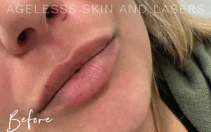 Before Image: Lip Filler