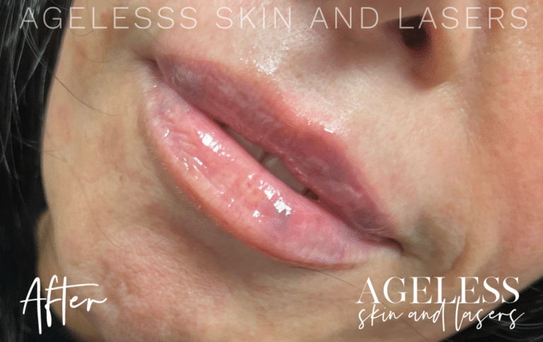 After Image: Lip Filler - left-front-oblique