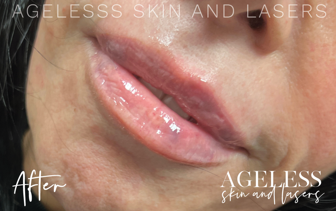 After Image: Lip Filler - left-front-oblique