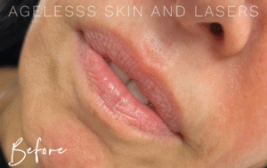 Before Image: Lip Filler