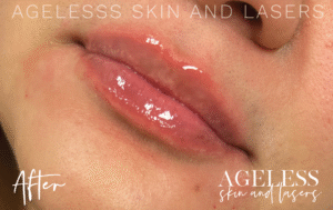 After Image: Lip Filler