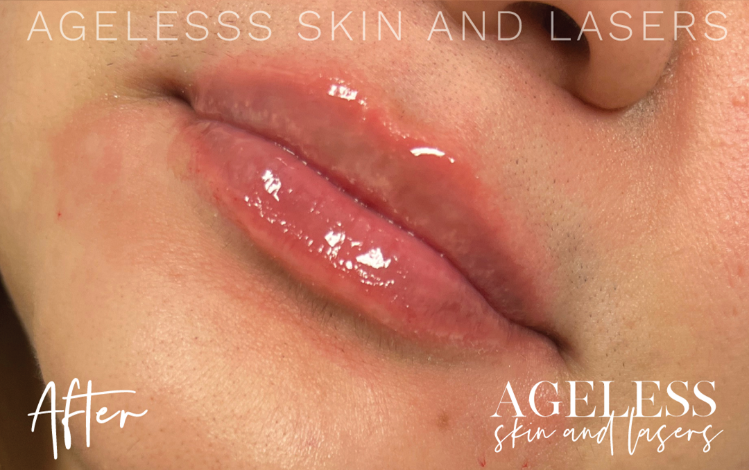 After Image: Lip Filler - left-front-oblique