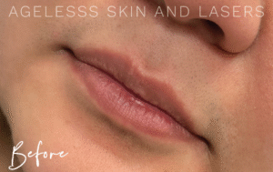 Before Image: Lip Filler