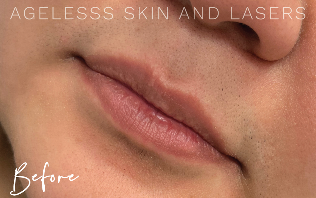 Before Image: Lip Filler - left-front-oblique