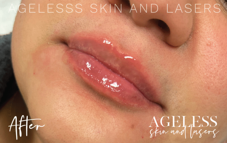 After Image: Lip Filler - left-front-oblique
