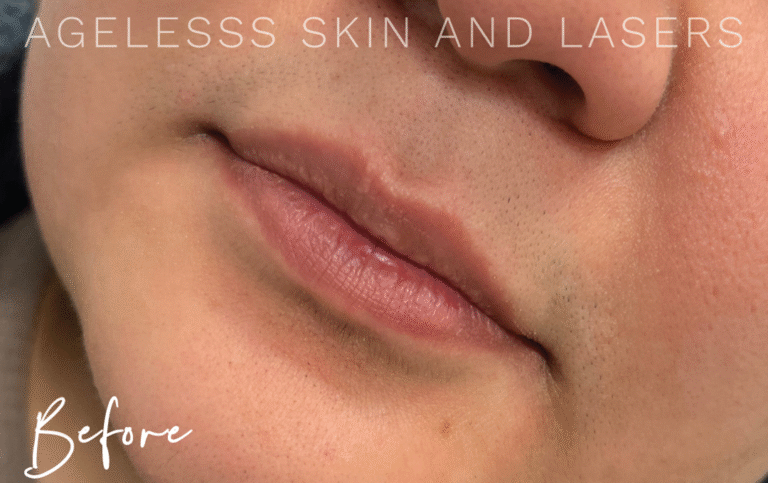 Before Image: Lip Filler - left-front-oblique