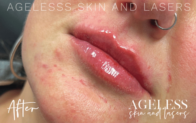 After Image: Lip Filler - left-front-oblique