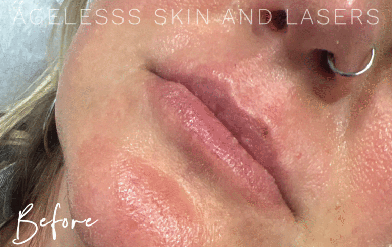 Before Image: Lip Filler - left-front-oblique