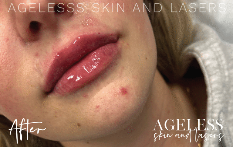 After Image: Lip Filler - right-front-oblique