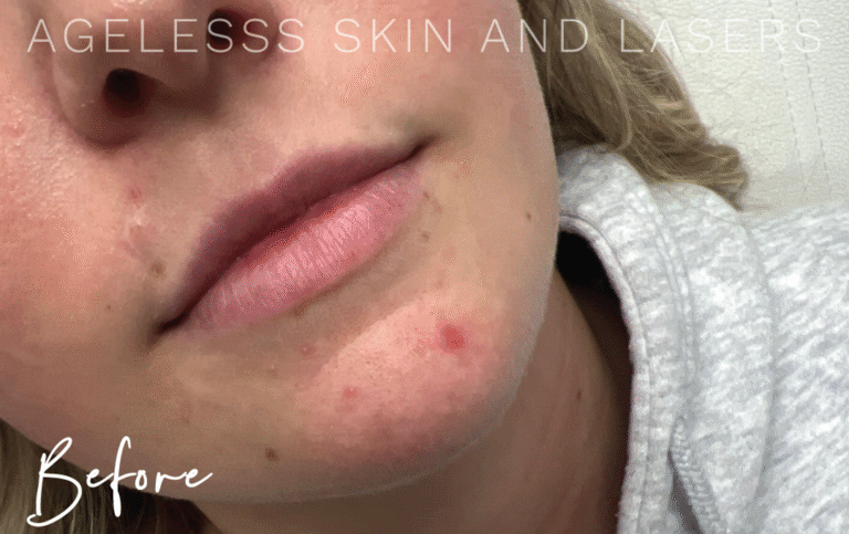 Before Image: Lip Filler - right-front-oblique