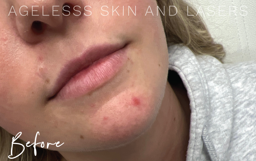 Before Image: Lip Filler - right-front-oblique