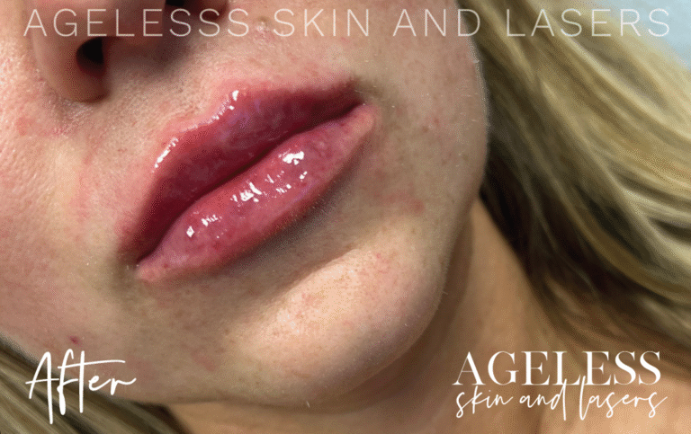 After Image: Lip Filler - right-front-oblique
