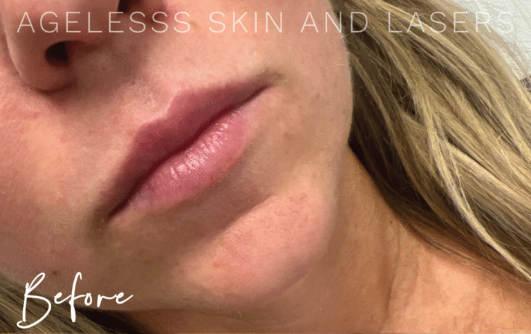Before Image: Lip Filler - right-front-oblique