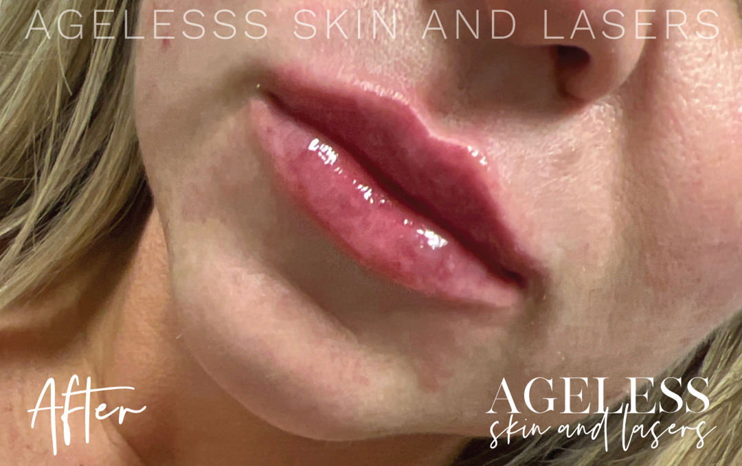 After Image: Lip Filler - left-front-oblique