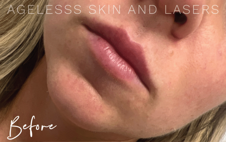 Before Image: Lip Filler - left-front-oblique